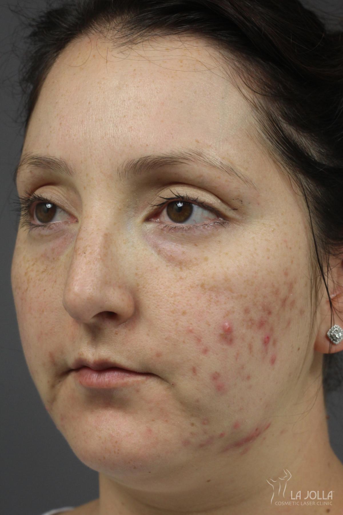 Acne Rejuvenation: Patient 6 - Before 1