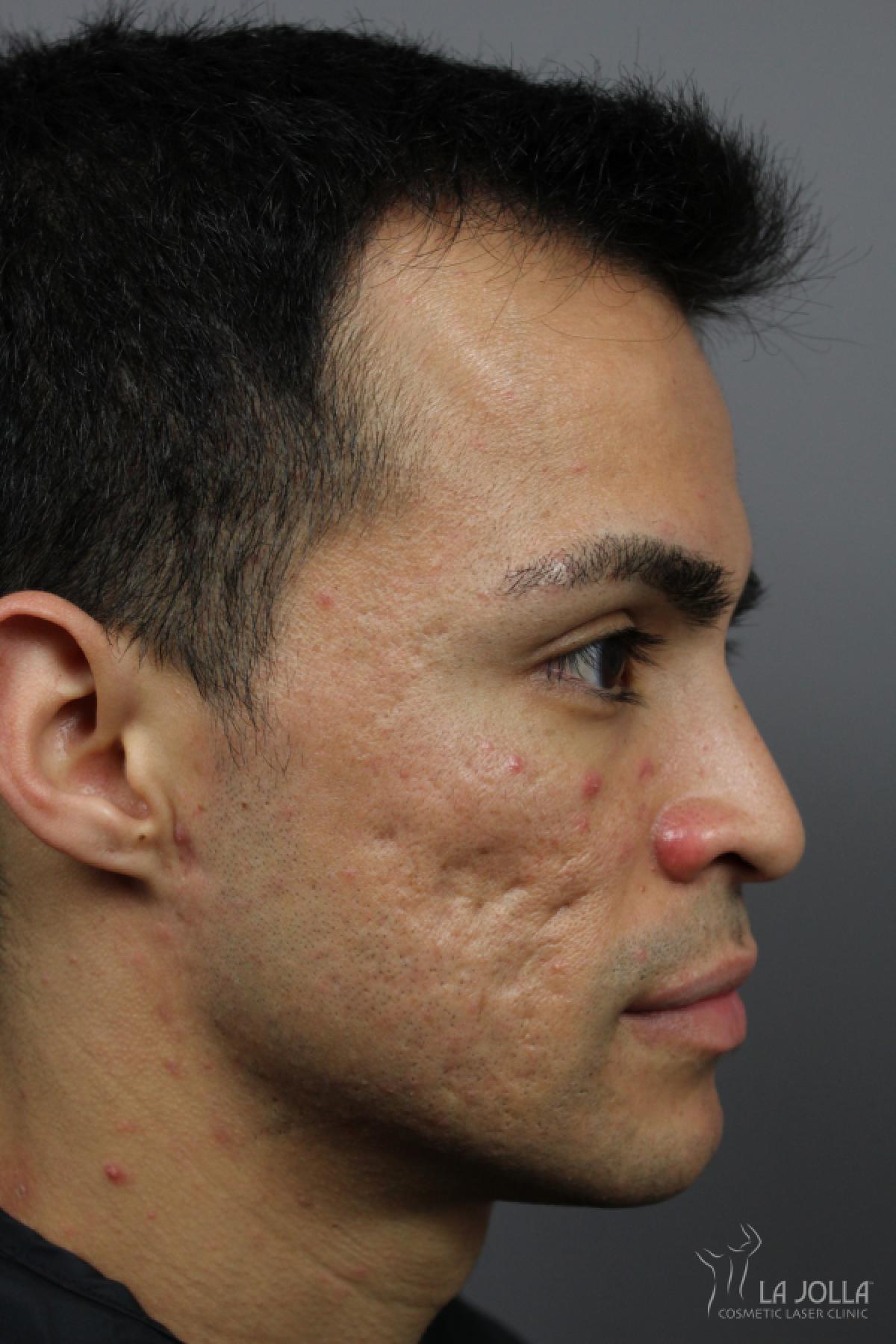 Acne Scars: Patient 4 - Before 3