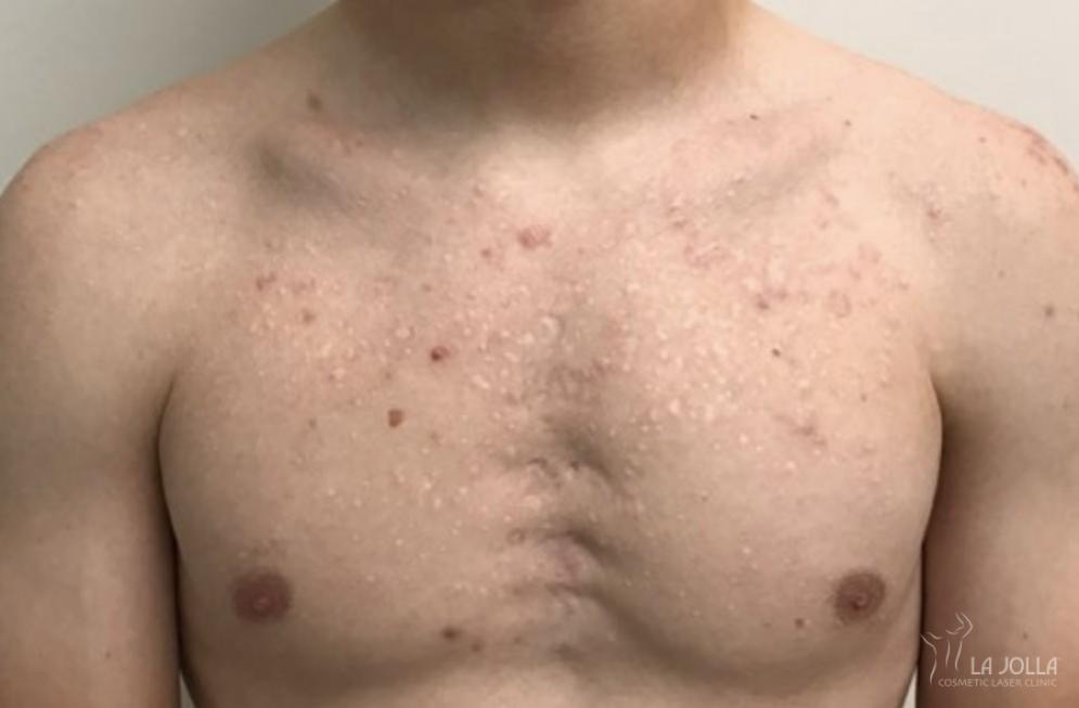 Fraxel Scar Before and After - Before 1