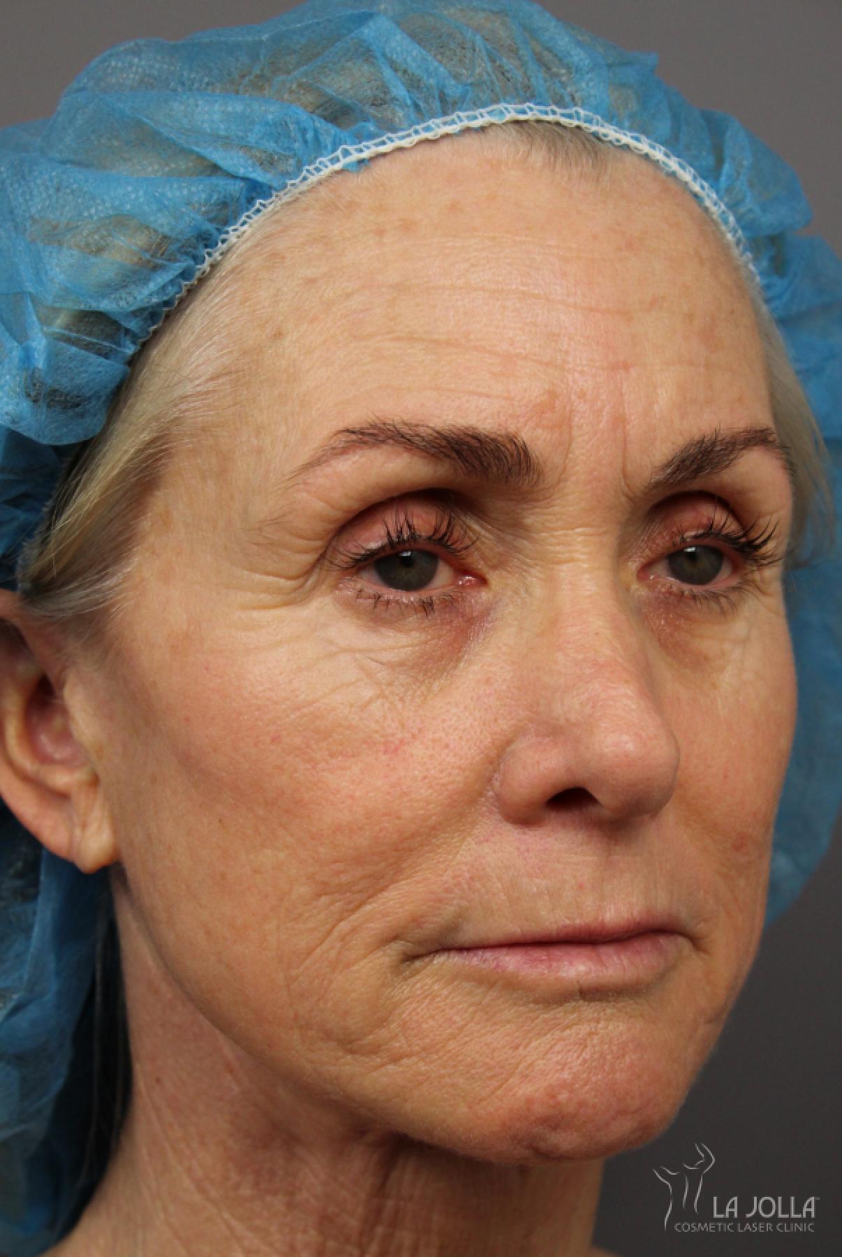 Laser Skin Resurfacing: Patient 1 - Before 2