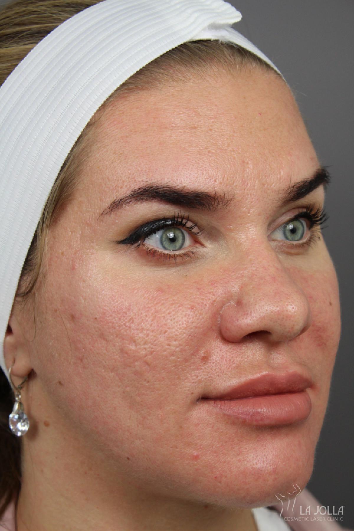 Lip Filler: Patient 16 - After 1