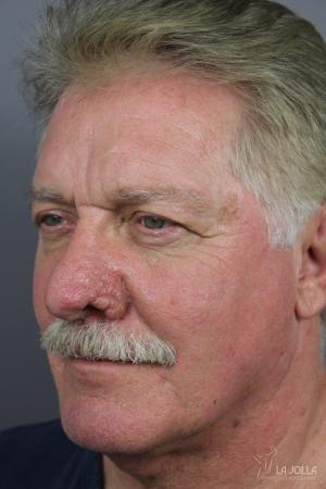 Lasers For Rhinophyma: Patient 1 - Before 