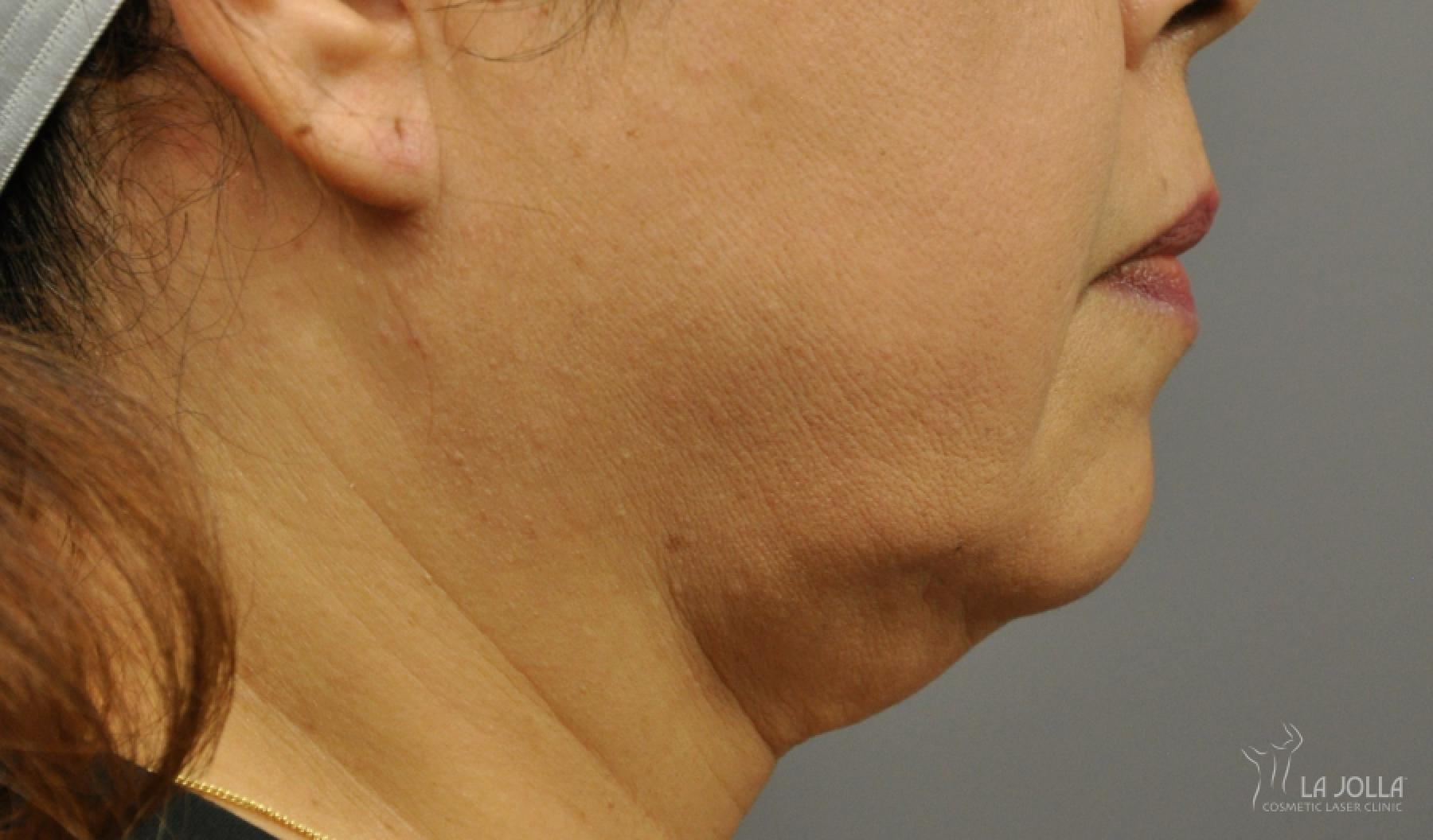 Kybella: Patient 4 - Before 1