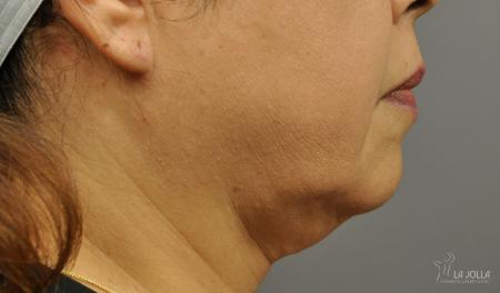 Kybella: Patient 4 - Before 