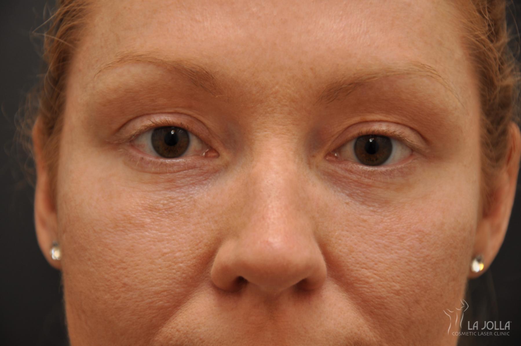 Under Eye Filler: Patient 3 - After  