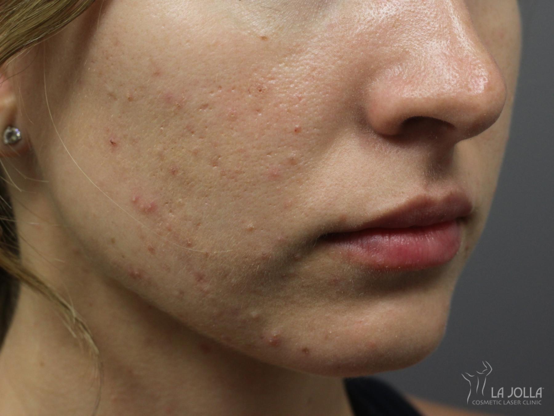Lip Filler: Patient 13 - After 2
