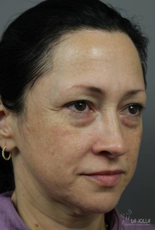 Sculptra®: Patient 4 - Before 