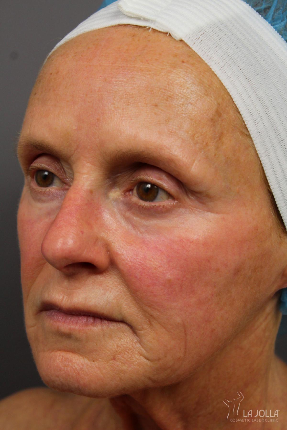 Laser Skin Resurfacing: Patient 2 - Before 1