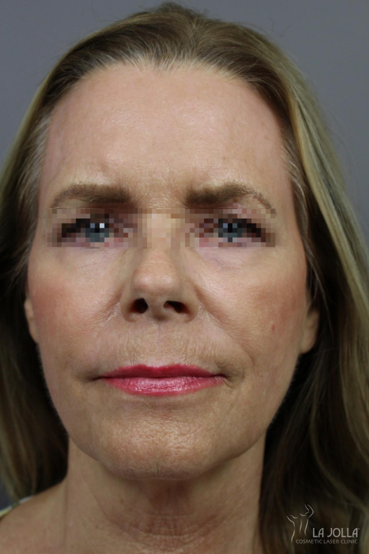CO2 Laser: Patient 17 - After 1