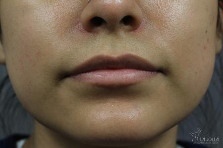 Juvéderm® XC: Patient 8 - Before 