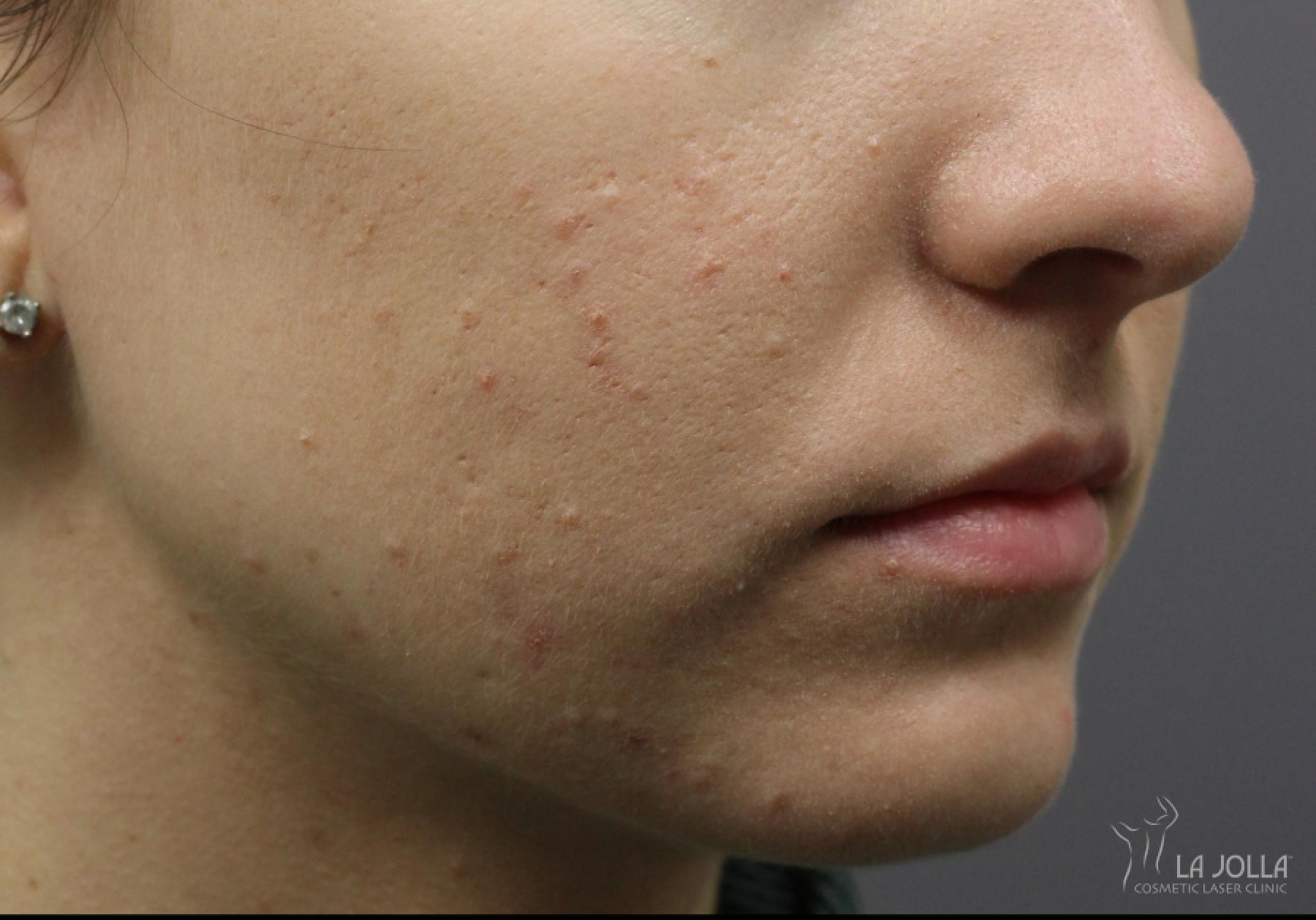 Lip Filler: Patient 13 - Before and After 2