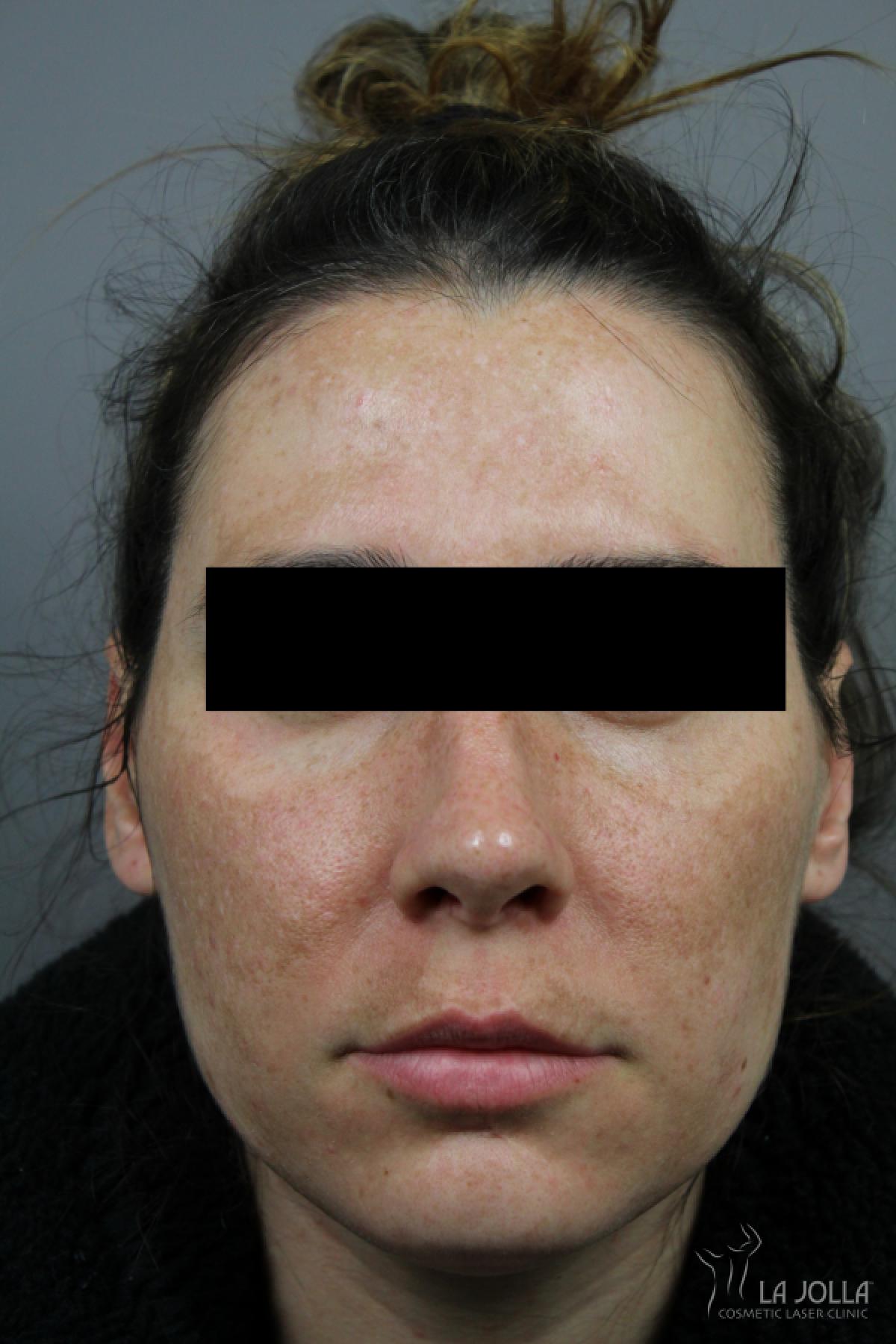 Chemical Peel: Patient 7 - Before 