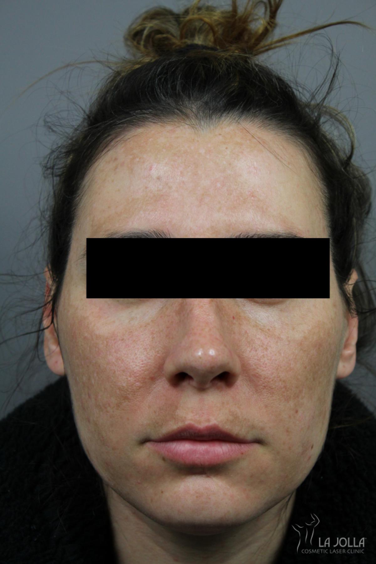 Chemical Peel: Patient 13 - Before 1