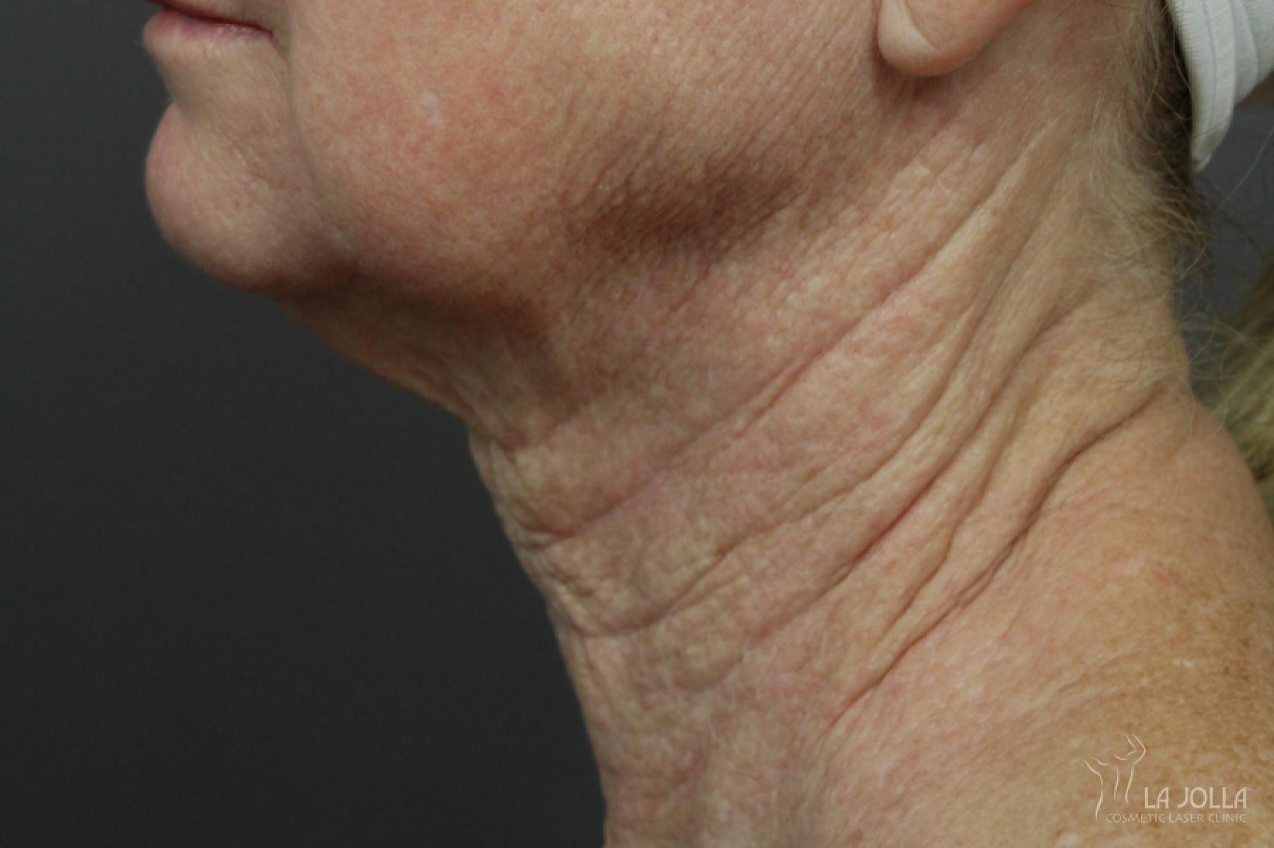 Non-Surgical Necklift: Patient 2 - After 2