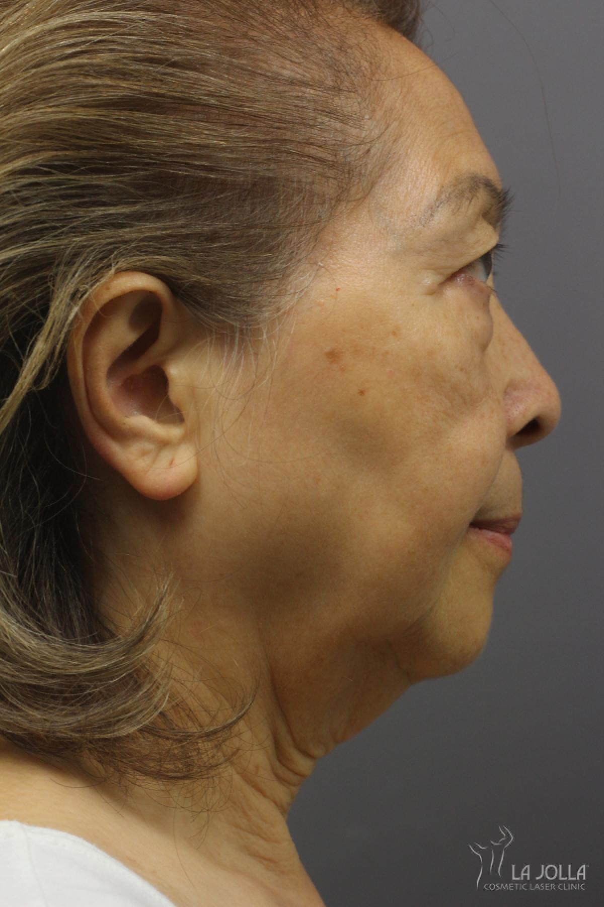 Ultherapy Patient 1 Before Procedure