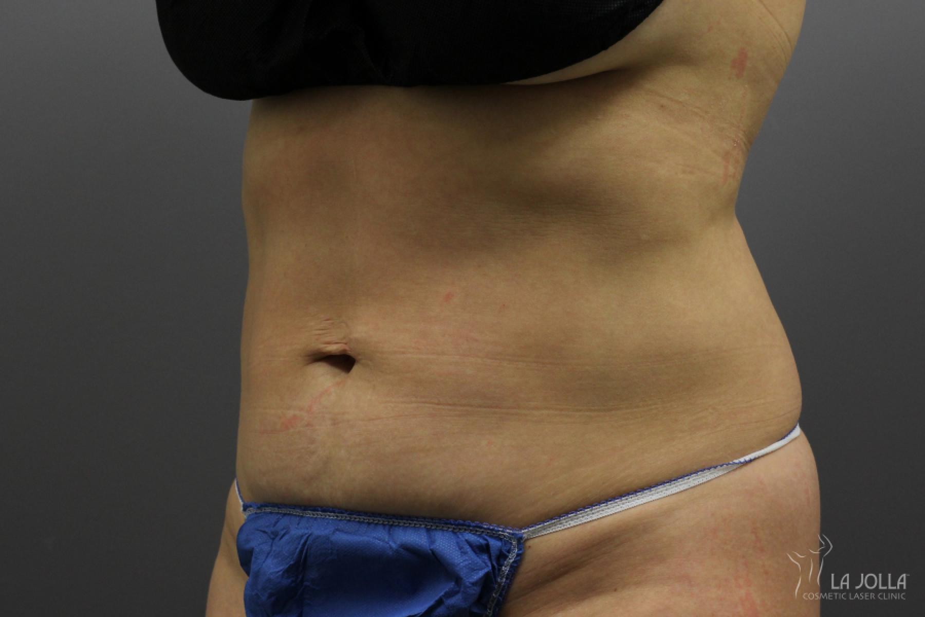 CoolSculpting®: Patient 6 - After  