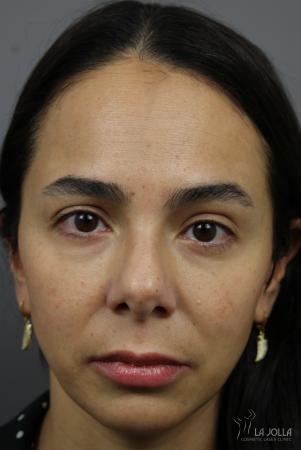 Sculptra®: Patient 9 - After  