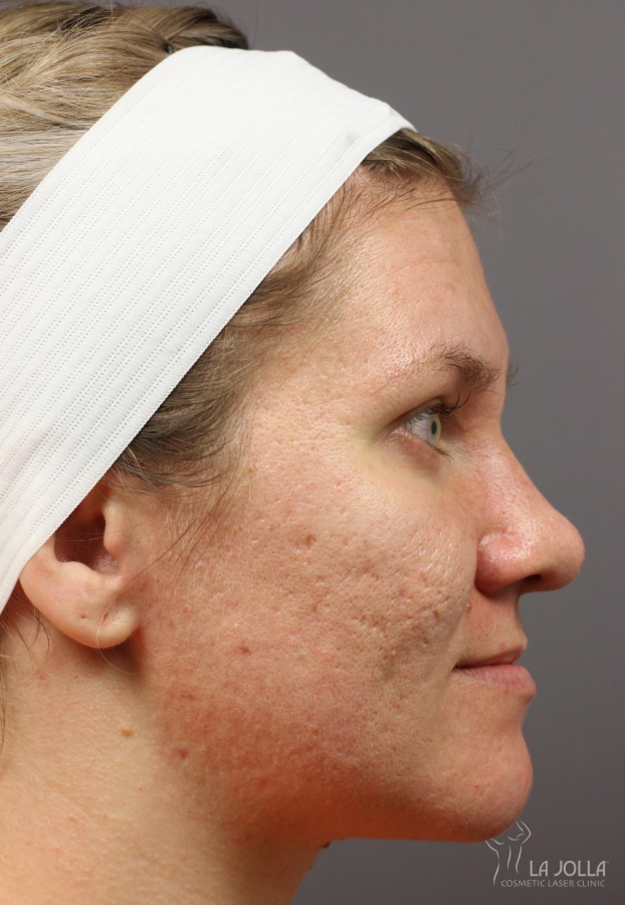 Lip Filler: Patient 16 - Before and After 2