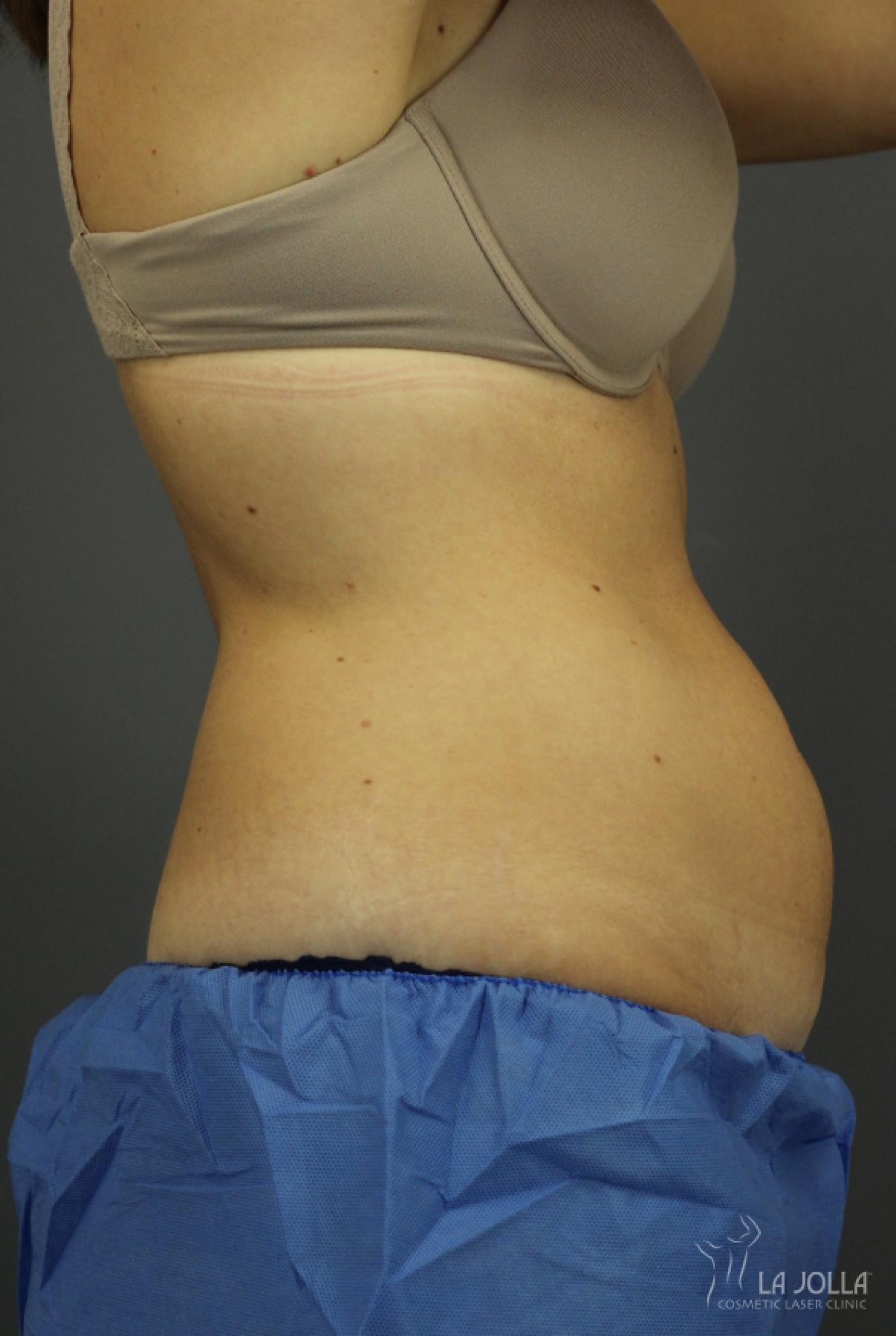 CoolSculpting Patient 2 Before Procedure