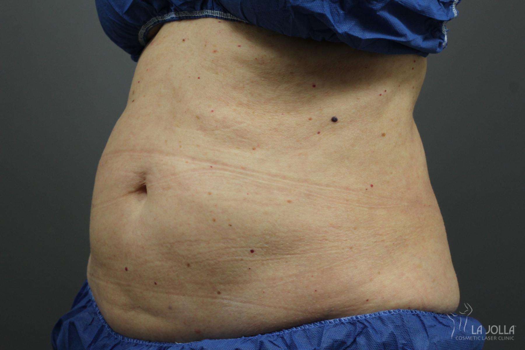 CoolSculpting®: Patient 10 - Before 