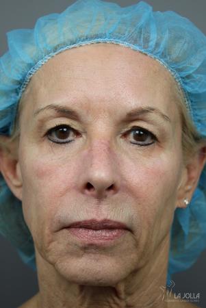 Sculptra®: Patient 8 - After  