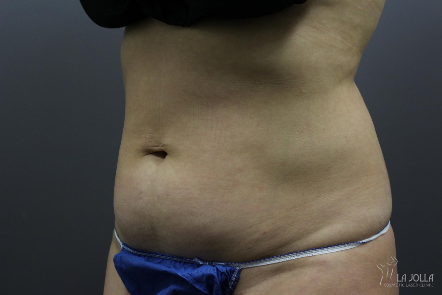 CoolSculpting®: Patient 6 - Before 