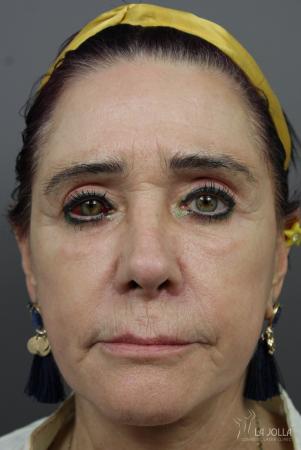 Sculptra®: Patient 7 - After  