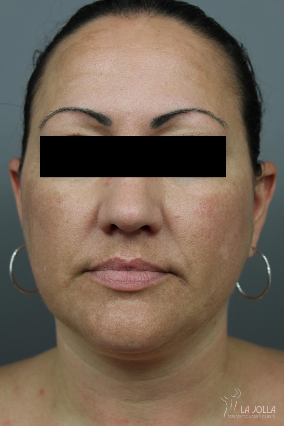 Kybella: Patient 2 - After 2