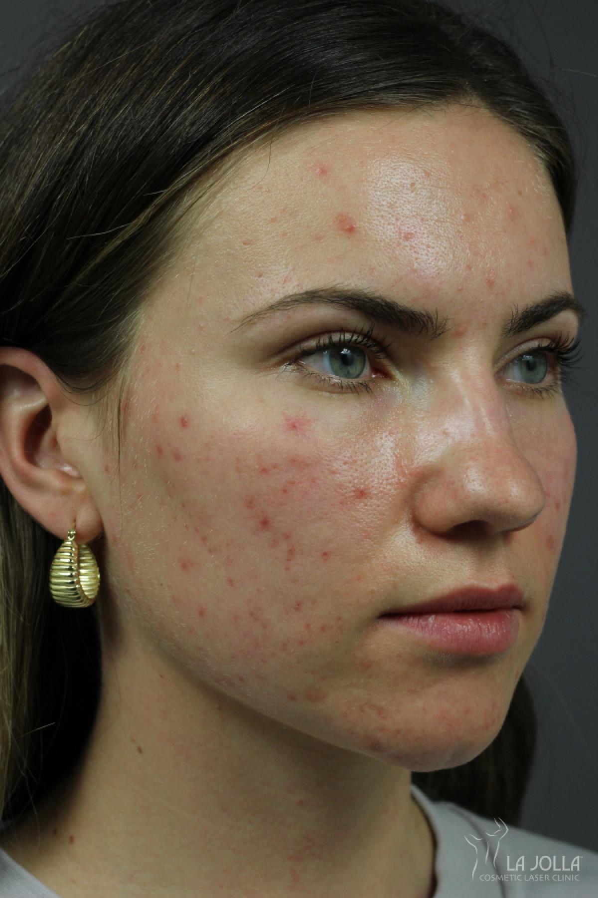 Acne Rejuvenation: Patient 7 - Before and After 2