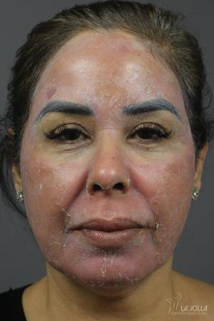 Chemical Peel: Patient 2 - After 1
