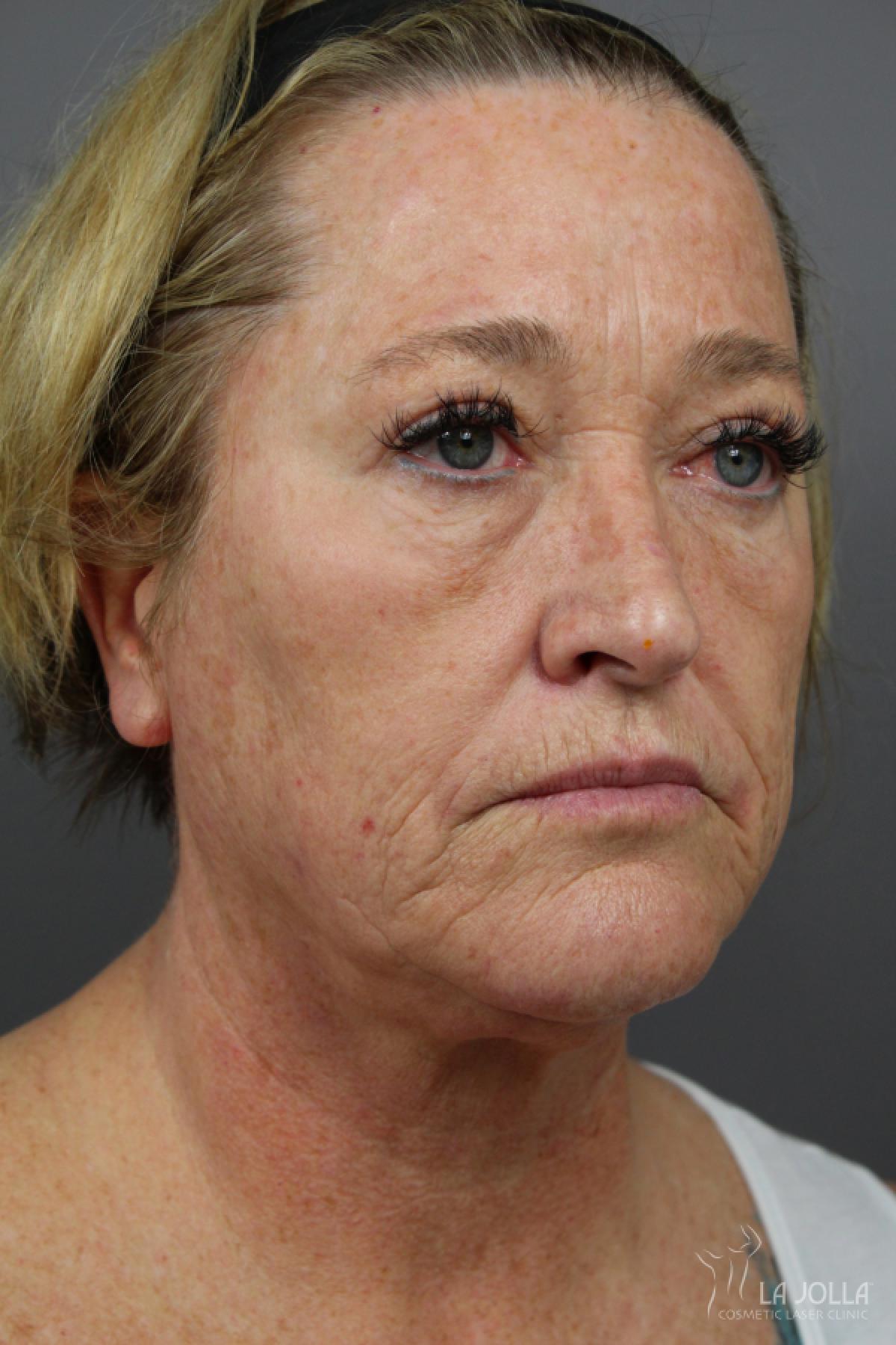 CO2 Laser: Patient 22 - Before 2