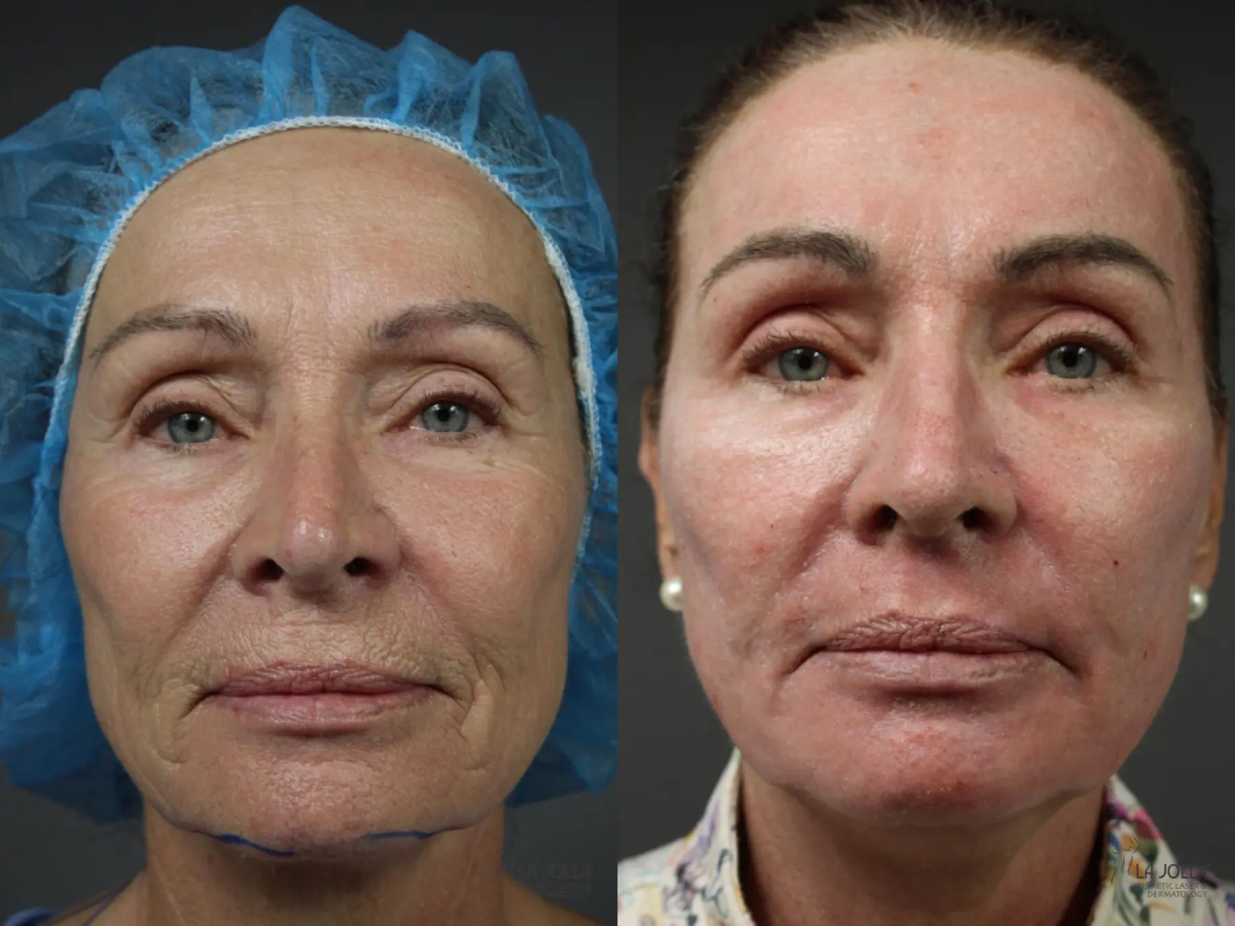 Ablative Laser Treatment: Patient 3 - Before and After  