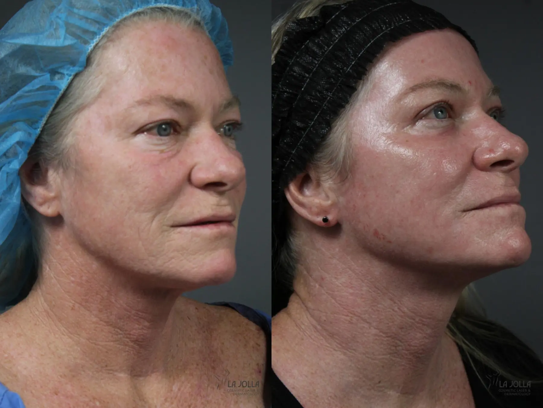 Ablative Laser Treatment: Patient 5 - Before and After 3