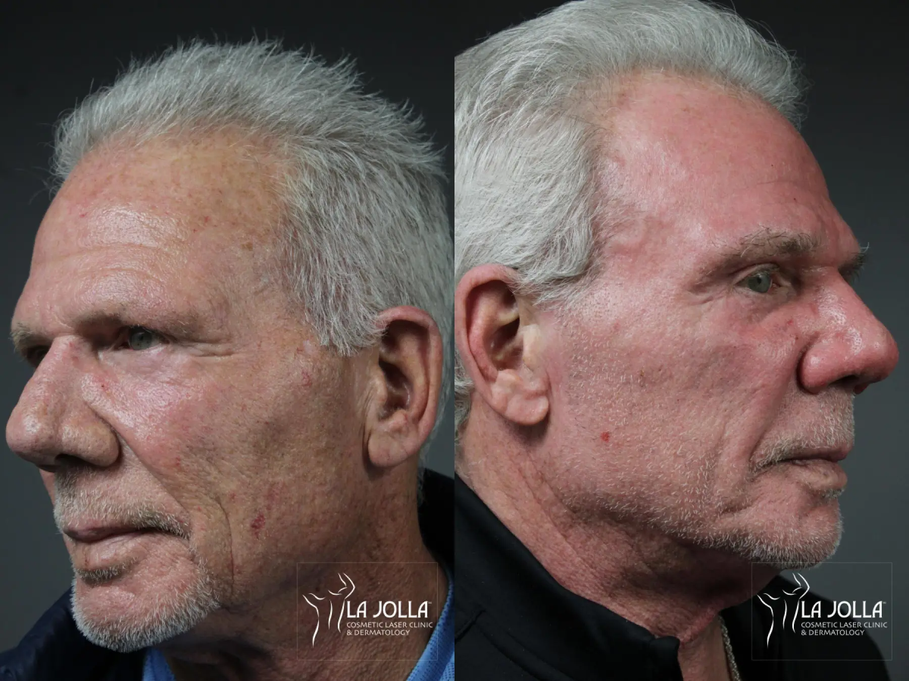 Ablative Laser Treatment: Patient 2 - Before and After 3