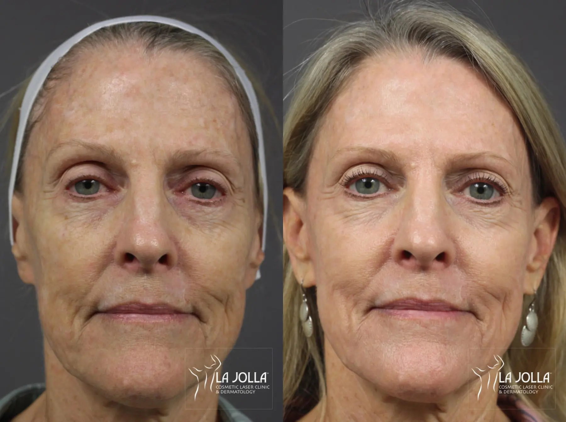 Ablative Laser Treatment: Patient 22 - Before and After 1