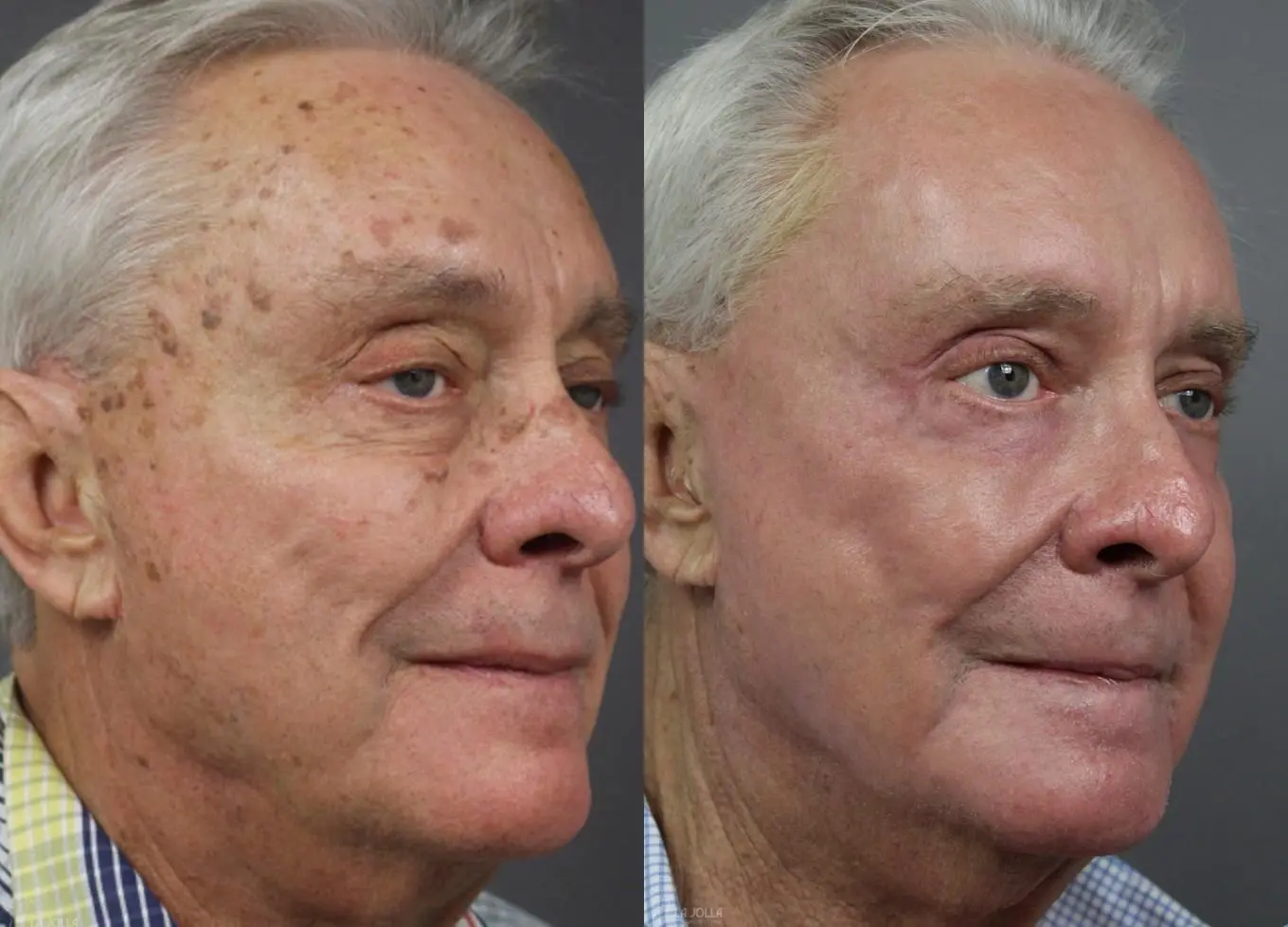 Ablative Laser Treatment: Patient 12 - Before and After 2