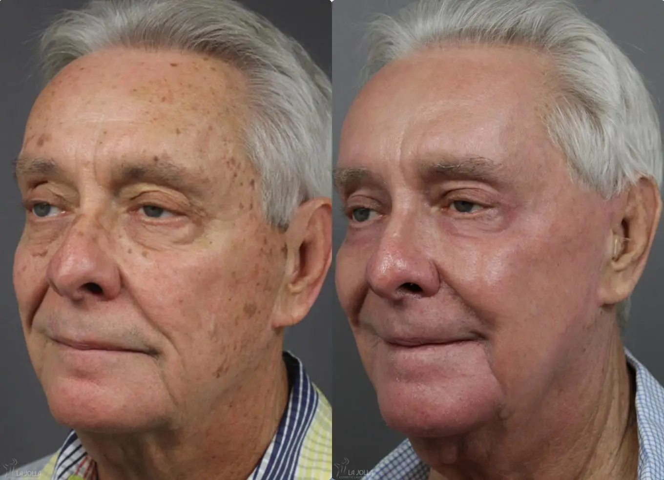 Ablative Laser Treatment: Patient 12 - Before and After 3