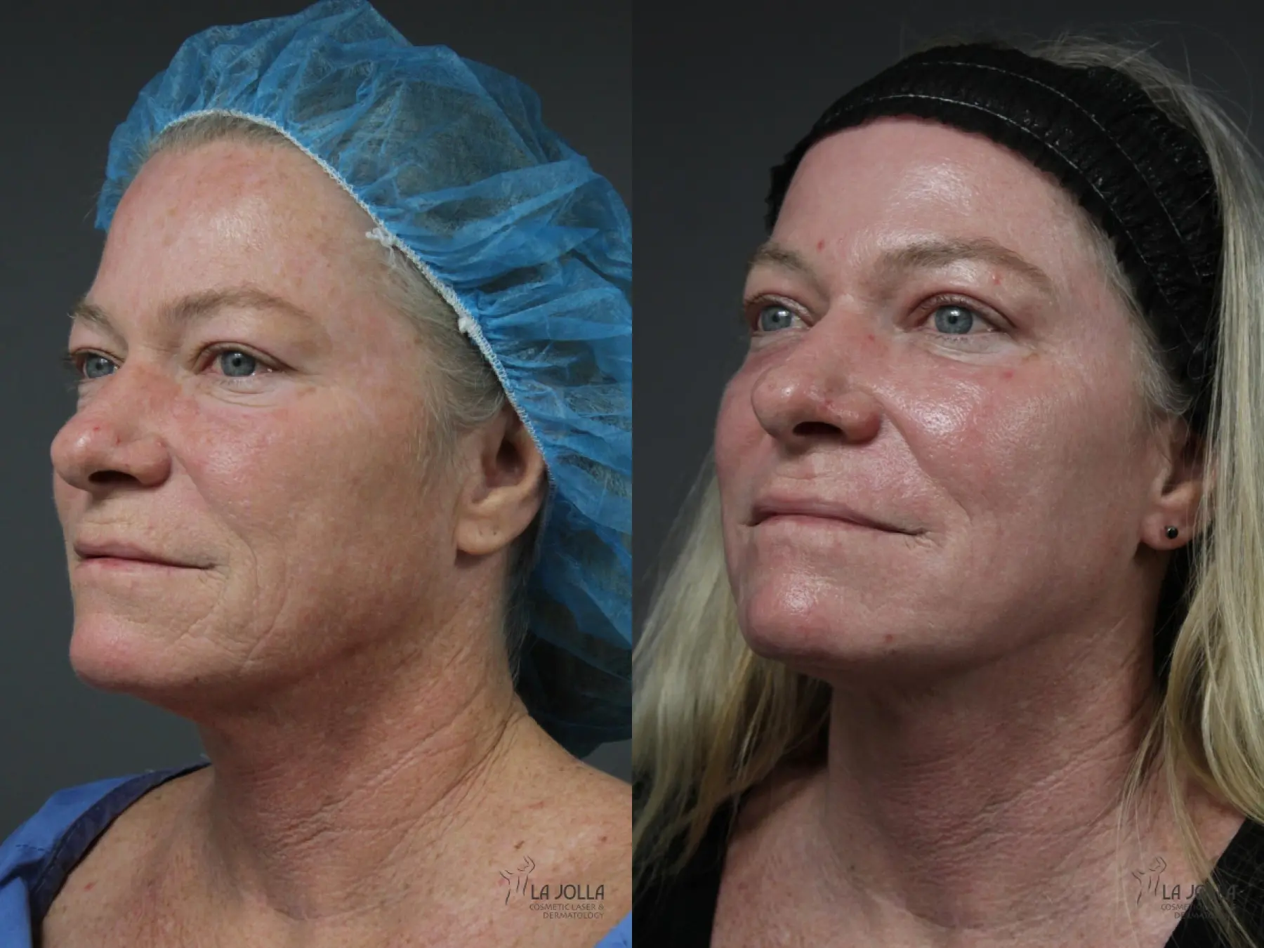 Ablative Laser Treatment: Patient 5 - Before and After 2