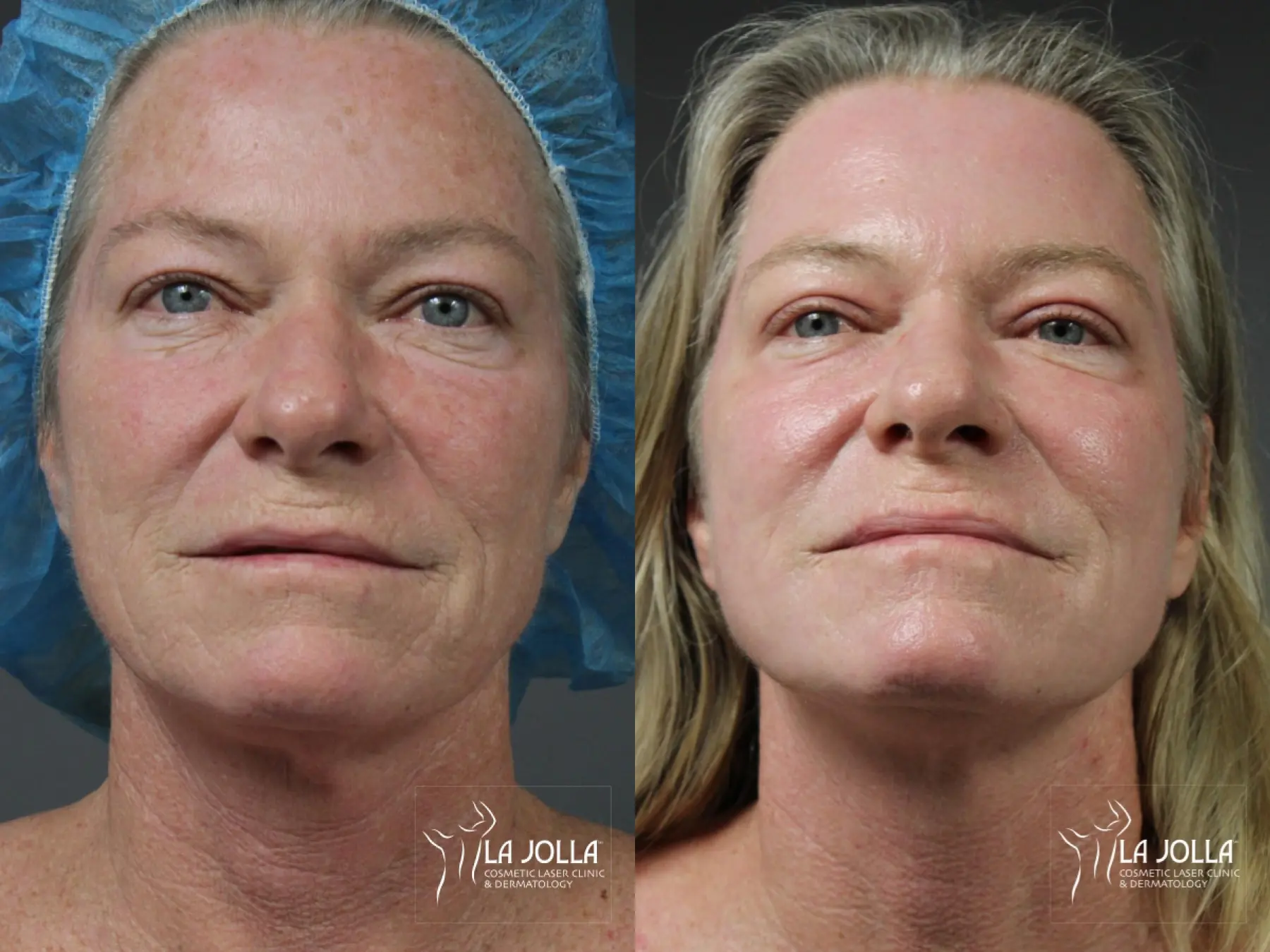 Ablative Laser Treatment: Patient 1 - Before and After  