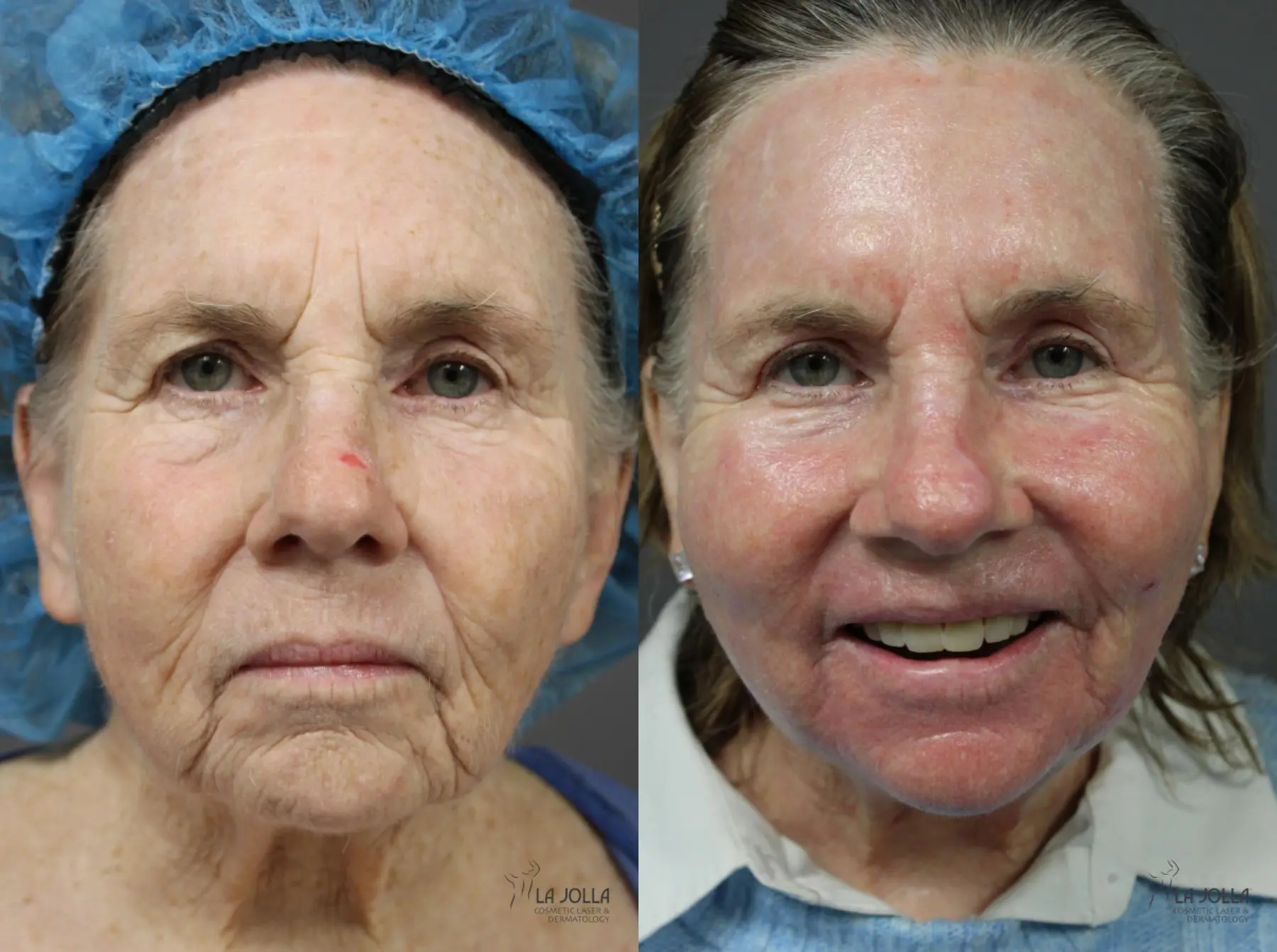 Ablative Laser Treatment: Patient 4 - Before and After  