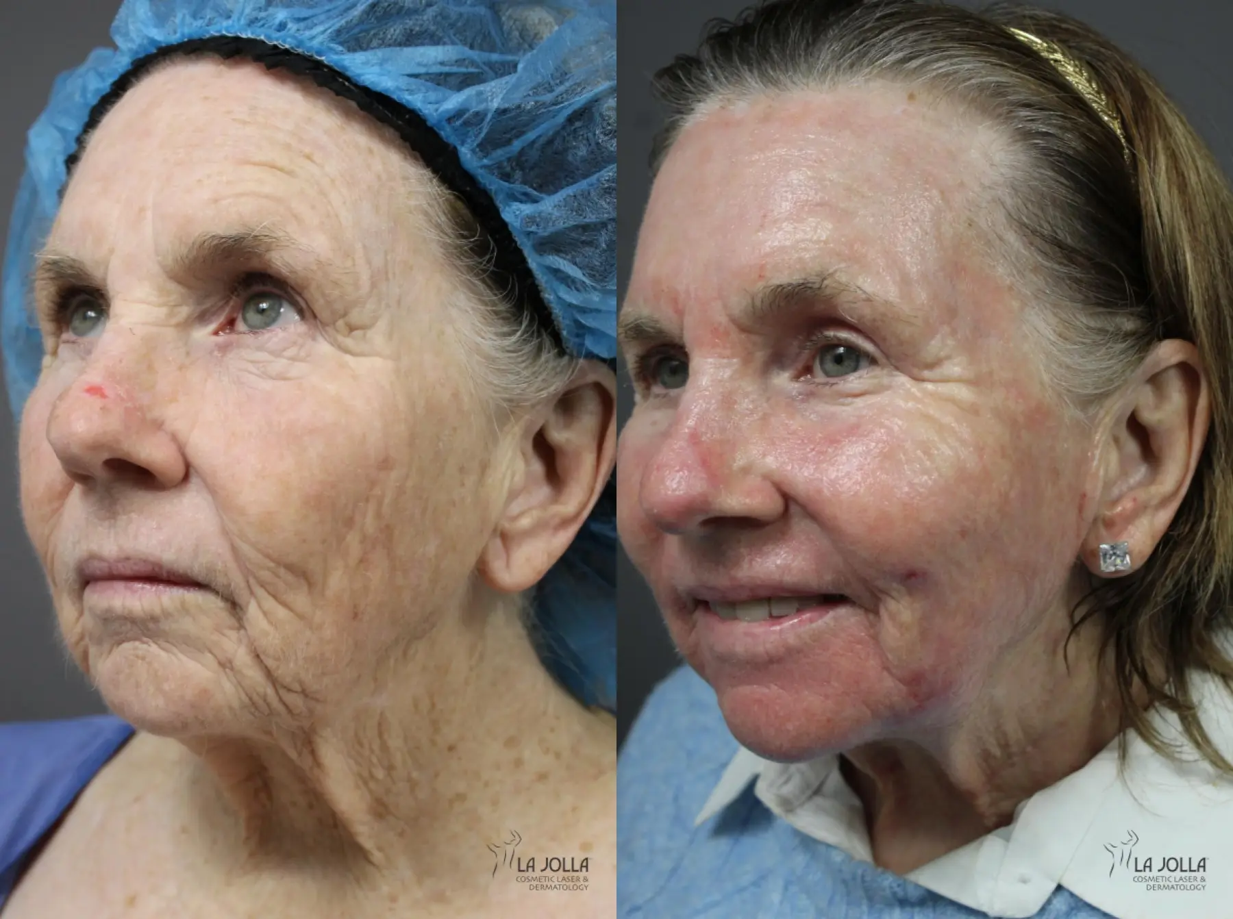 Ablative Laser Treatment: Patient 4 - Before and After 3