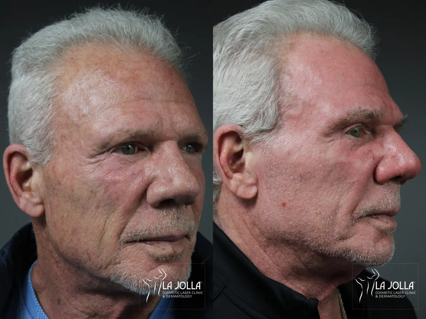 Ablative Laser Treatment: Patient 2 - Before and After 2