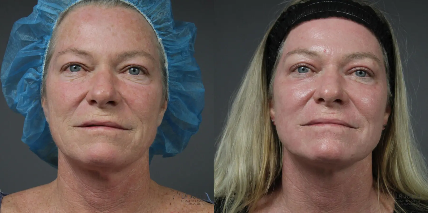 Ablative Laser Treatment: Patient 5 - Before and After  
