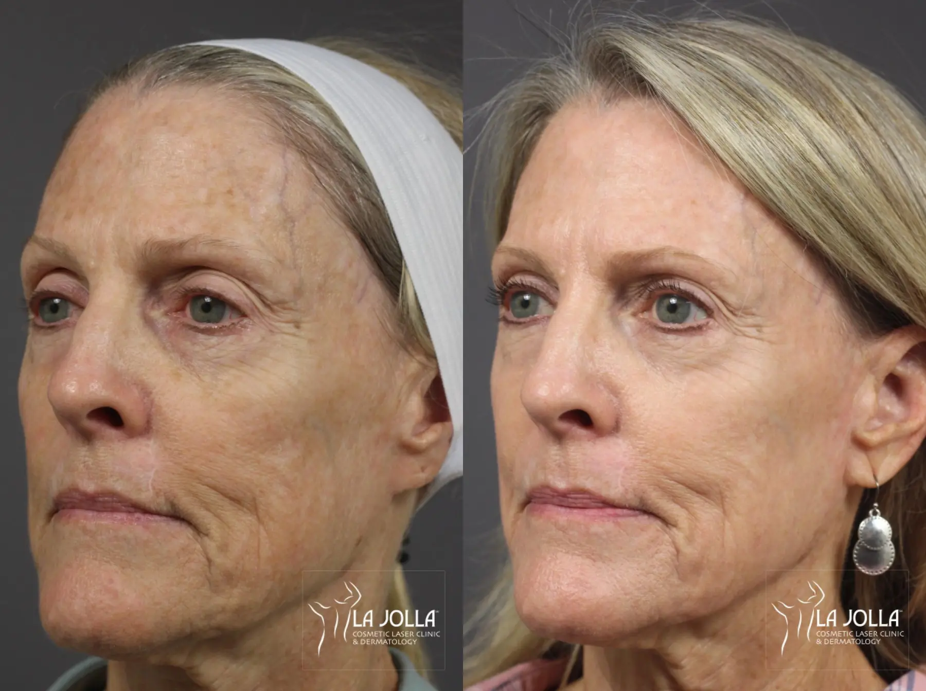 Ablative Laser Treatment: Patient 22 - Before and After 2
