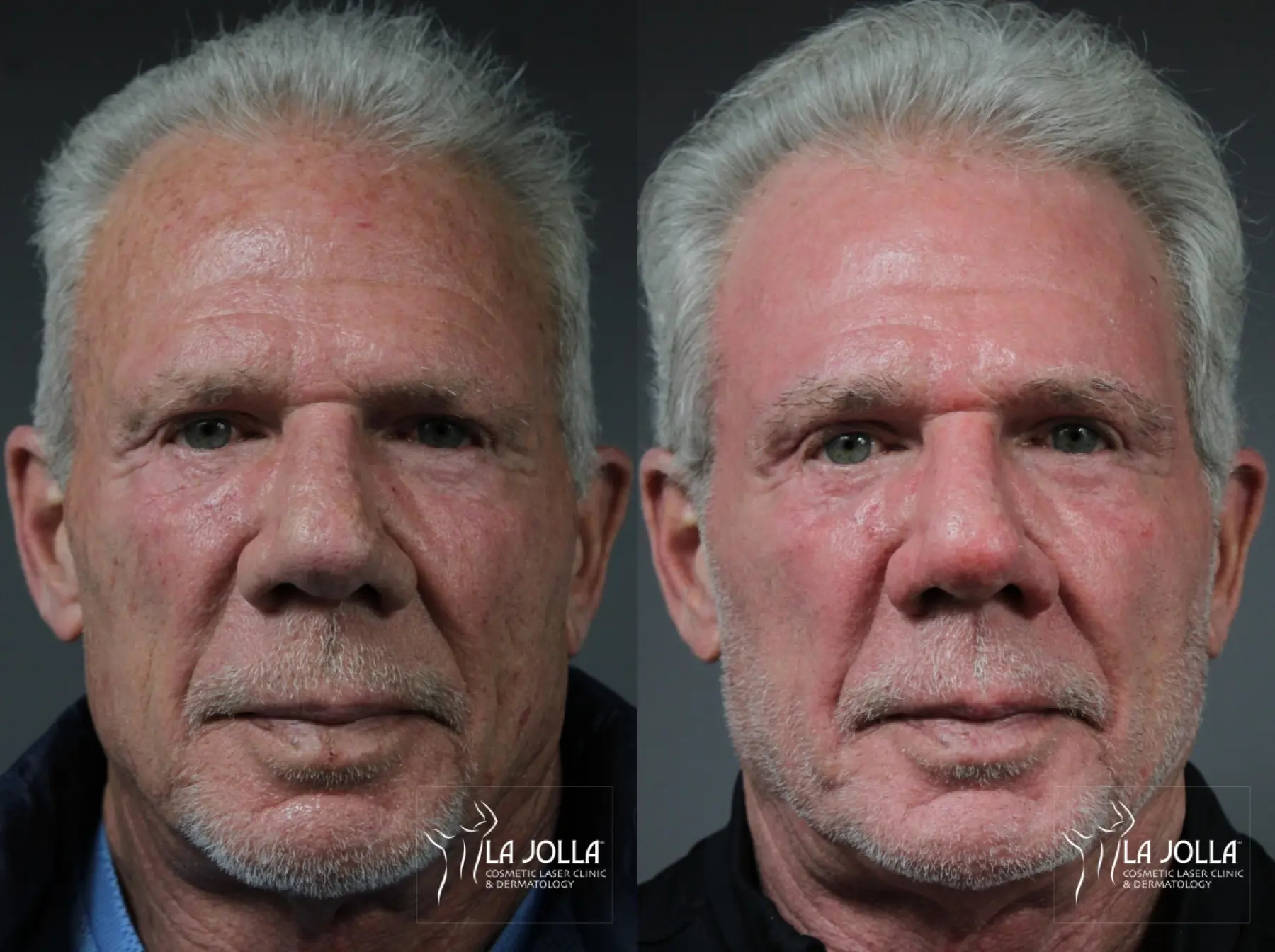 Ablative Laser Treatment: Patient 2 - Before and After  