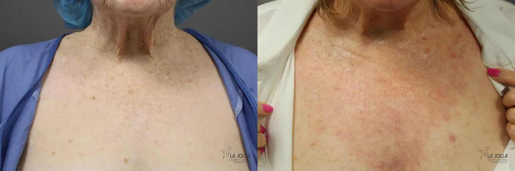 Ablative Laser Treatment: Patient 4 - Before and After 4