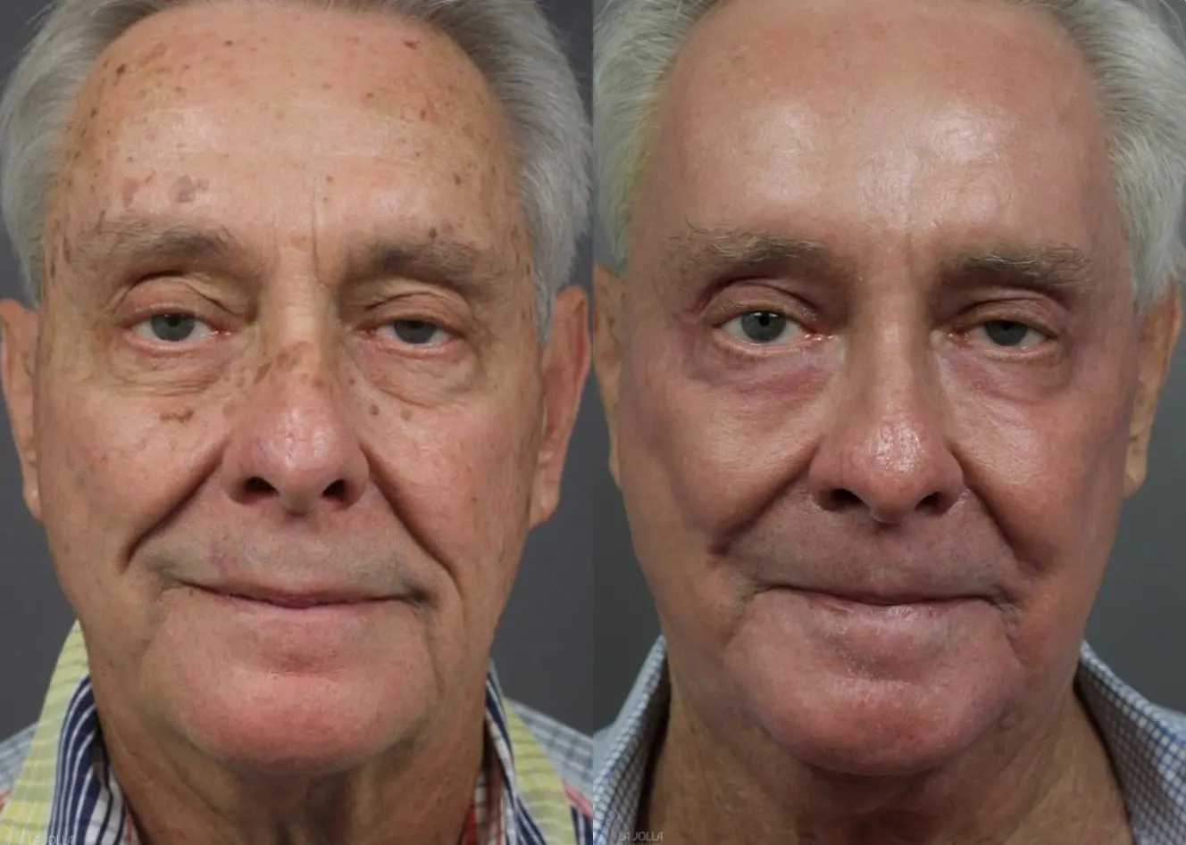 Ablative Laser Treatment: Patient 12 - Before and After 1