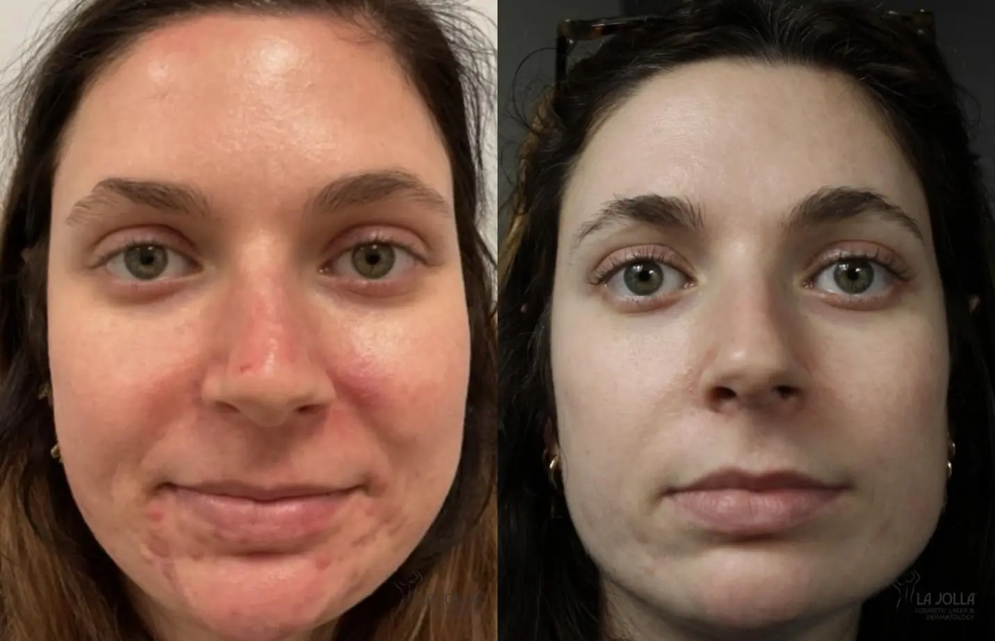 Acne: Patient 1 - Before and After  