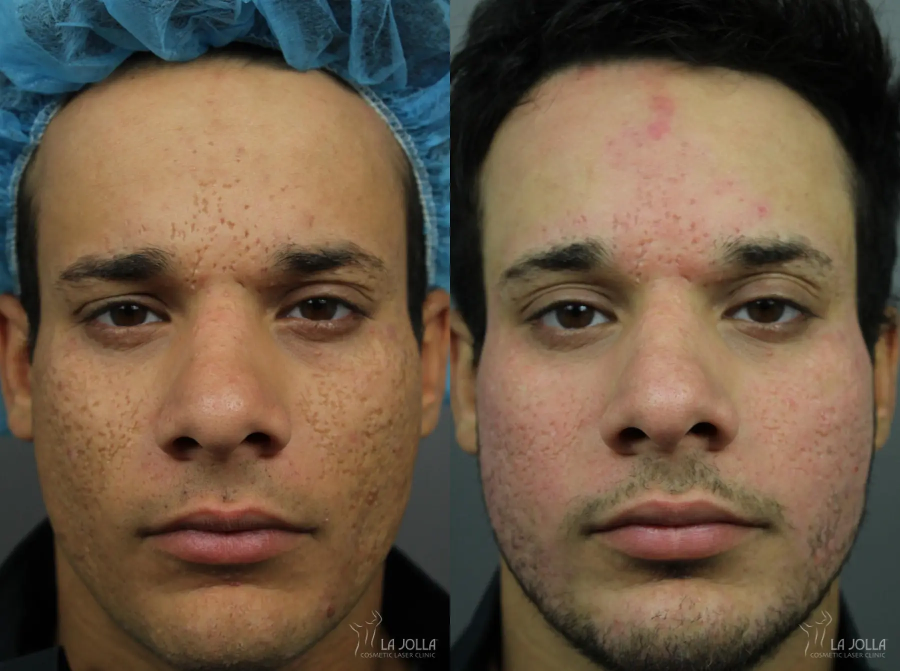 Acne Scars: Patient 10 - Before and After 1