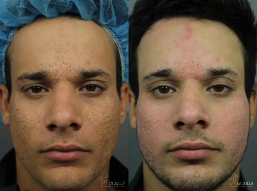 Acne Scars: Patient 10 - Before and After  